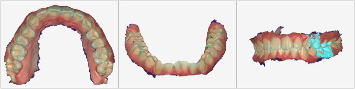 What is 3D Intraoral Scanning?